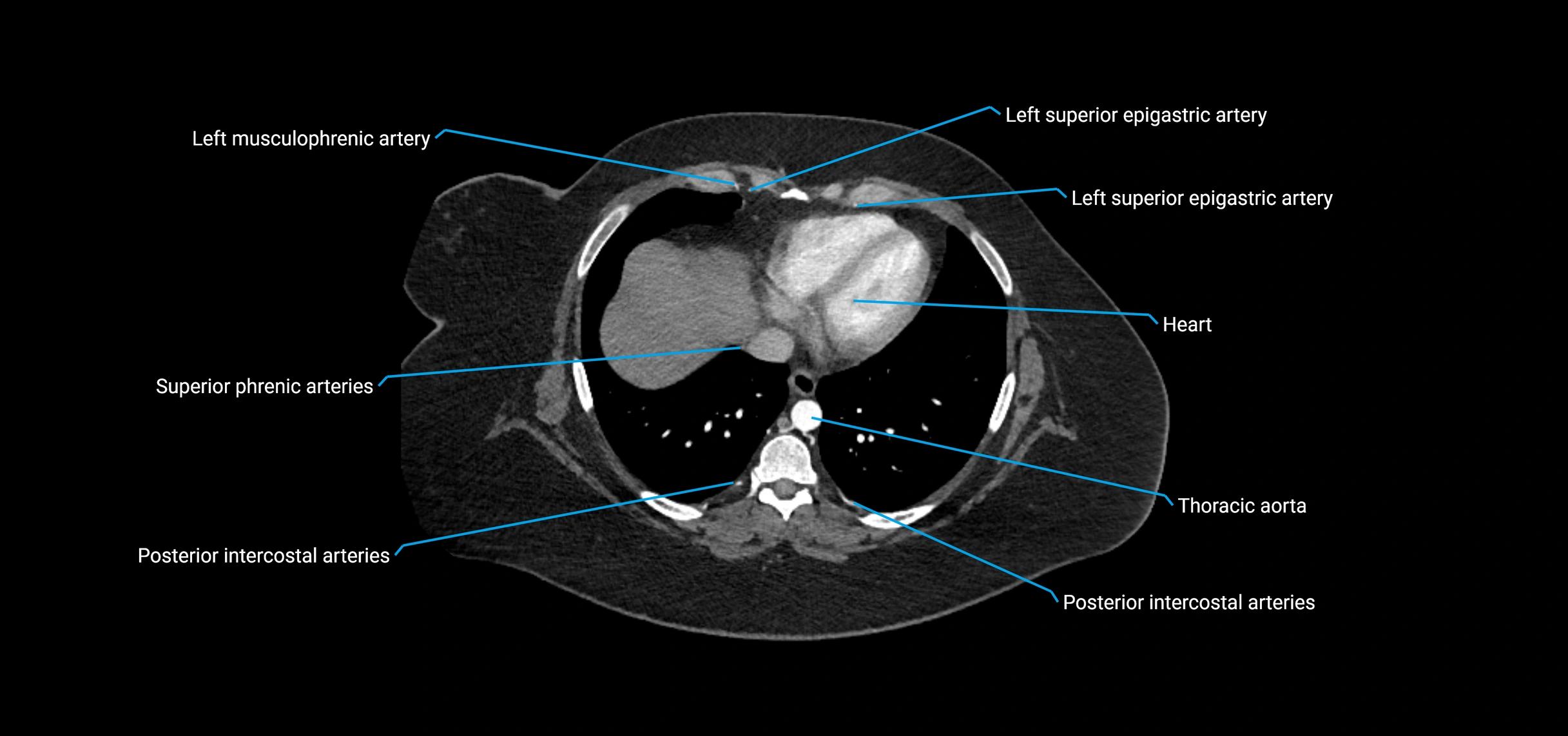 CTA abdomen axial cross sectional anatomy labelled image_10 (1).webp